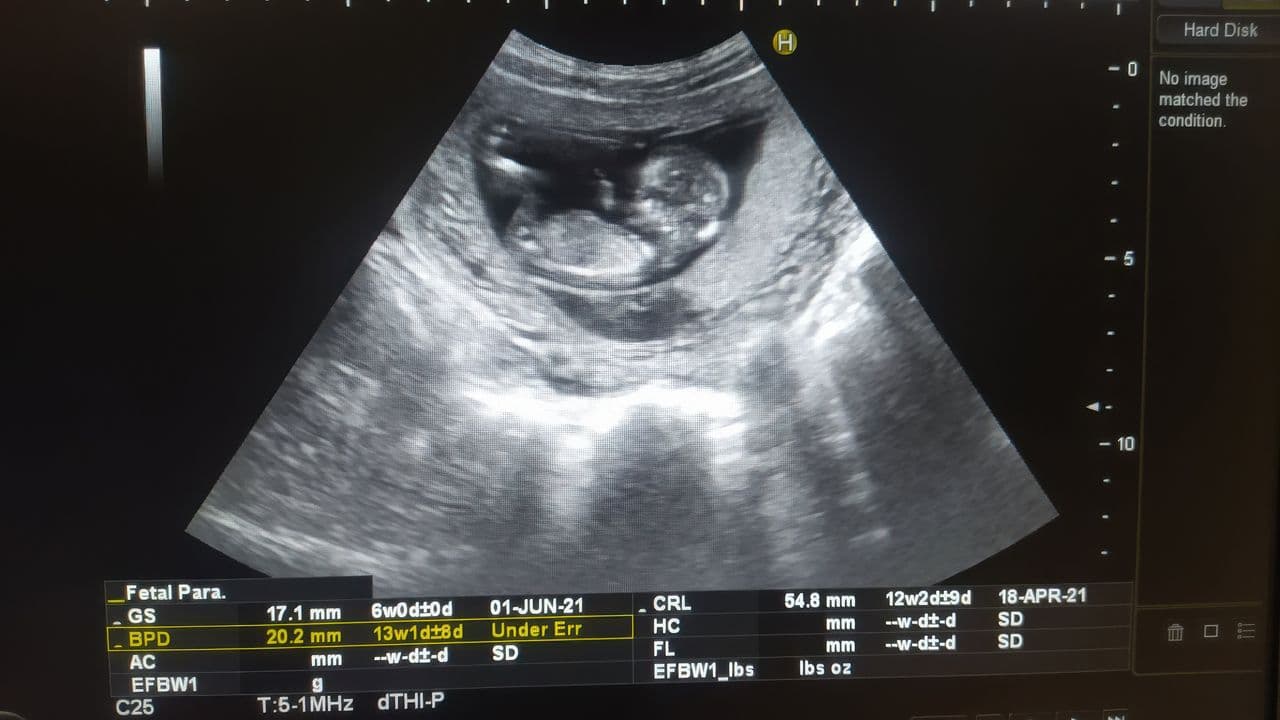 Pfas nei feti: esposizione prenatale molto più grave del previsto